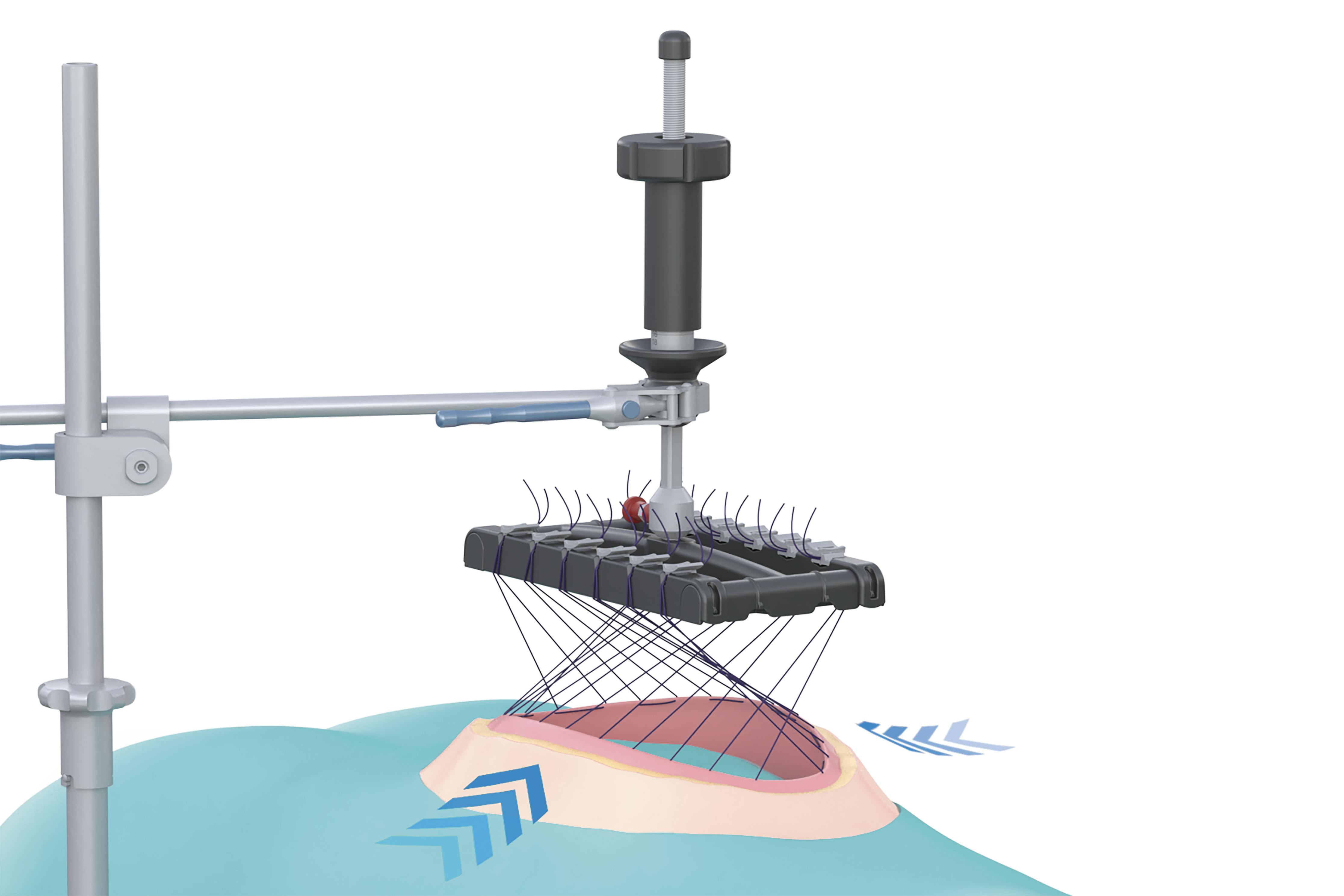 fasciotens® Hernia Produktbild